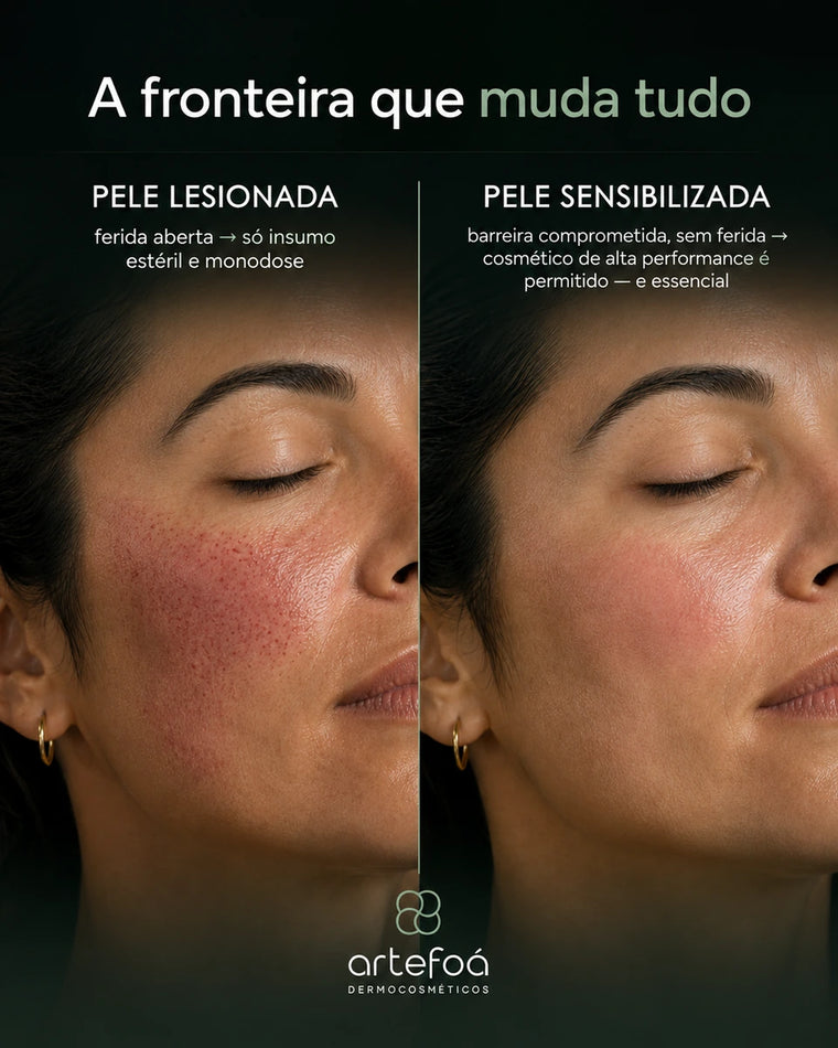 Pele lesionada pede insumo estéril e monodose. Pele sensibilizada aceita cosmético de alta performance.